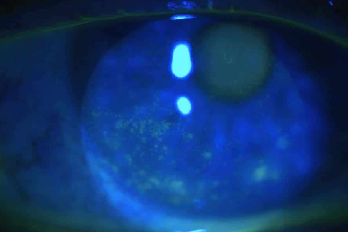 ocular_surface_-disease_-treatment_2.jpg